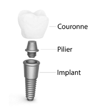 L'implantologie